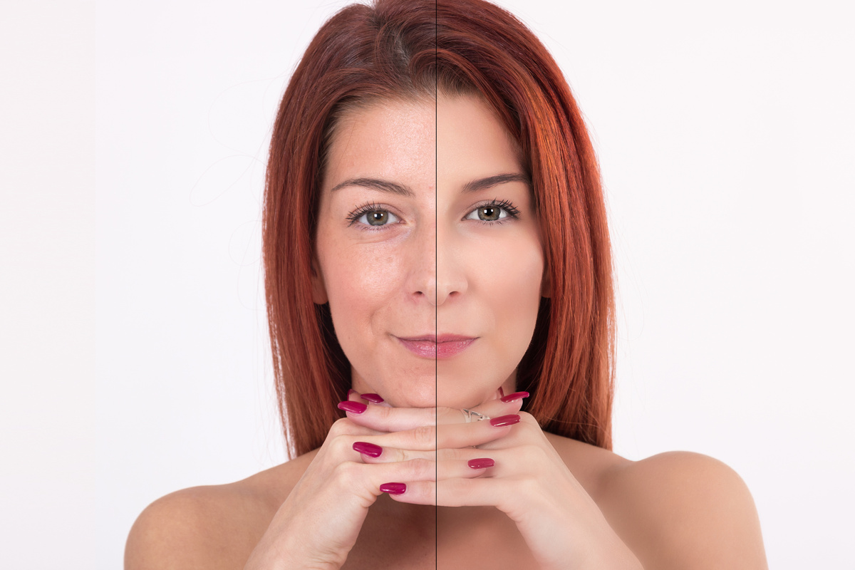 Before and after Beauty Treatment