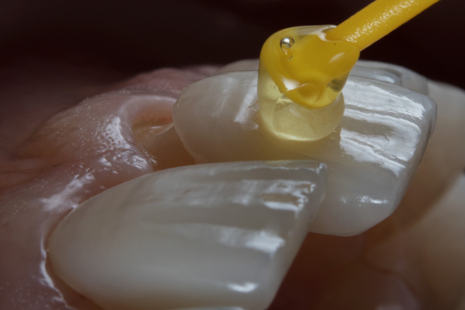 Porcelain veneers before fixation