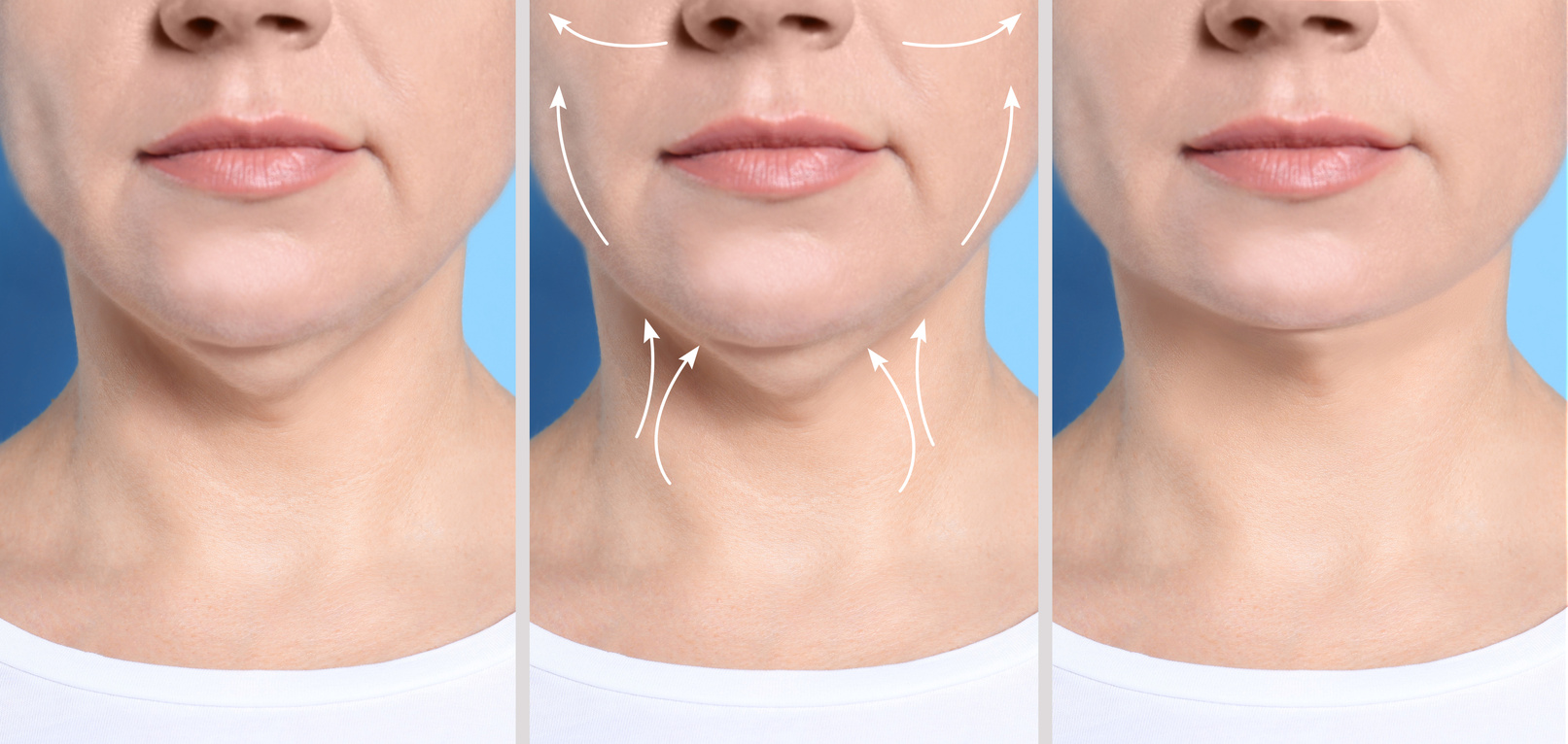 Before and After of Double Chin Plastic Surgery Operation